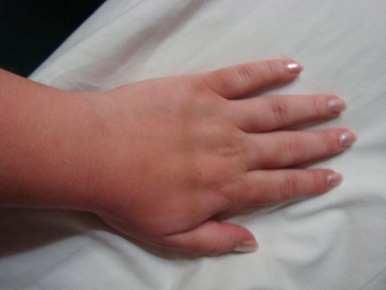 Afecţiuni ale pielii provocate de radiaţiile ultraviolete 96734