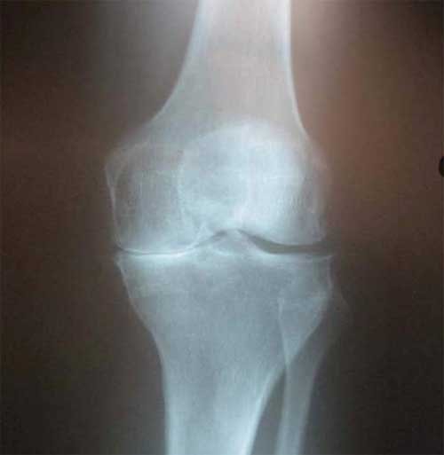 tampoane genunchi pentru tratamentul artrozei
