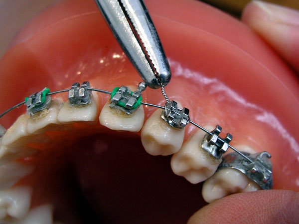 Când sunt recomandate aparatele dentare 98027