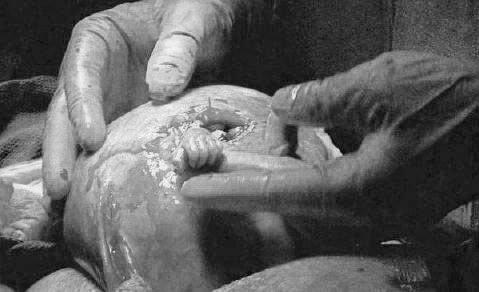 Noi progrese în chirurgia fetală 103638