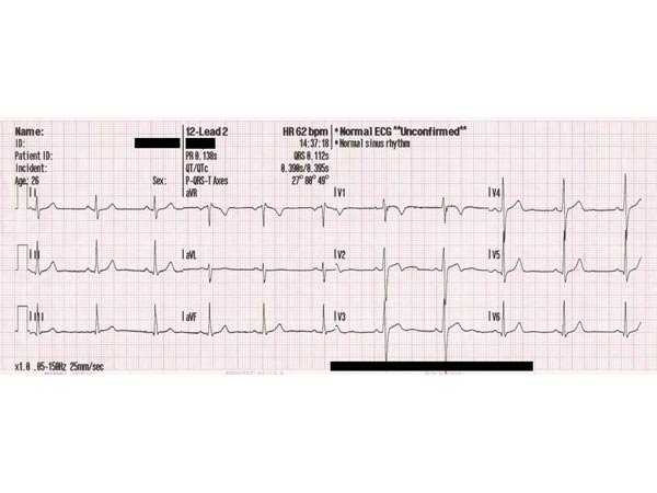 „Măştile“ bolilor coronariene 103906