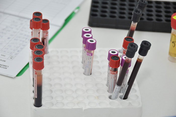 Depresia, depistată în urma analizelor de sânge 108244