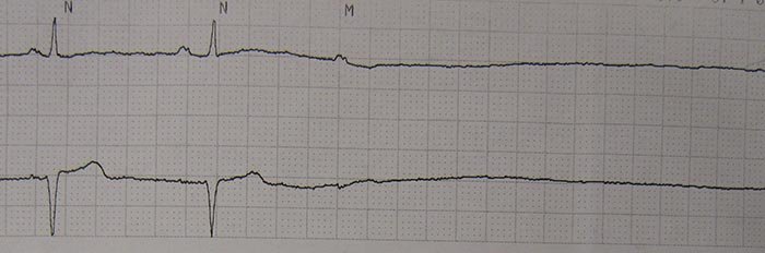 Muşchiul inimii, reparat cu ajutorul celulelor suşă cardiace 110042