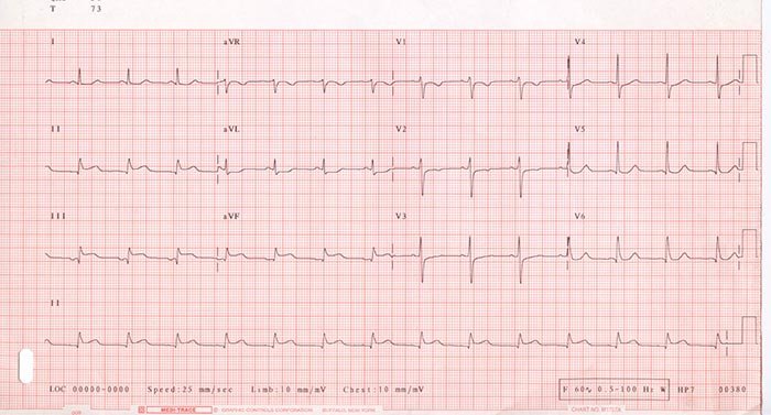Infarctul miocardic şi efectele sale asupra vieţii de familie 110857
