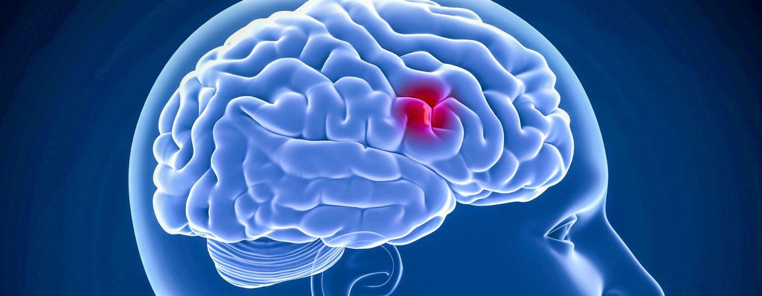 Recuperarea corectă în caz de accidente cerebrale 8723