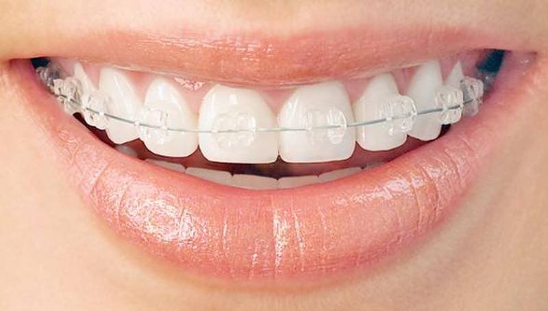 Vouchere pentru aparate ortodontice 117680