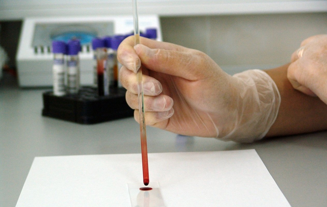 Teste rapide pentru diagnosticarea hepatitei C 121379