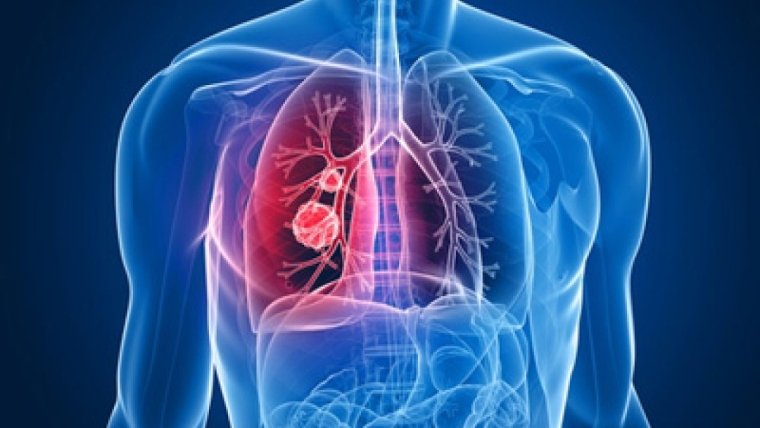 Platformă online pentru testarea biomarkerilor în cancerul pulmonar 135693