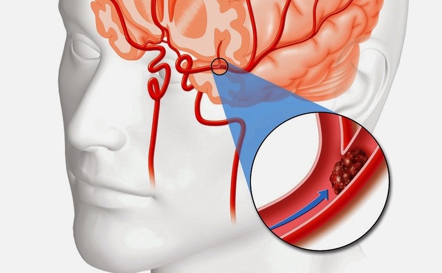 Optimiștii se pot recupera mai repede după AVC 140066