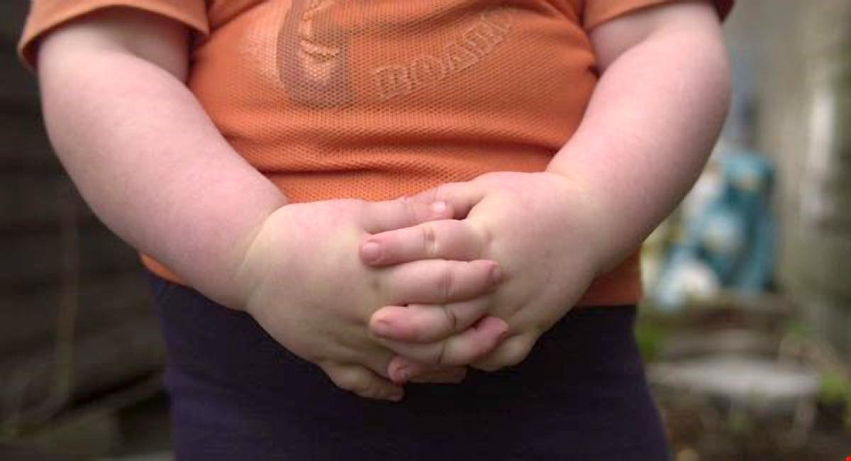 Obezitatea în copilărie, risc de scleroză multiplă 151588