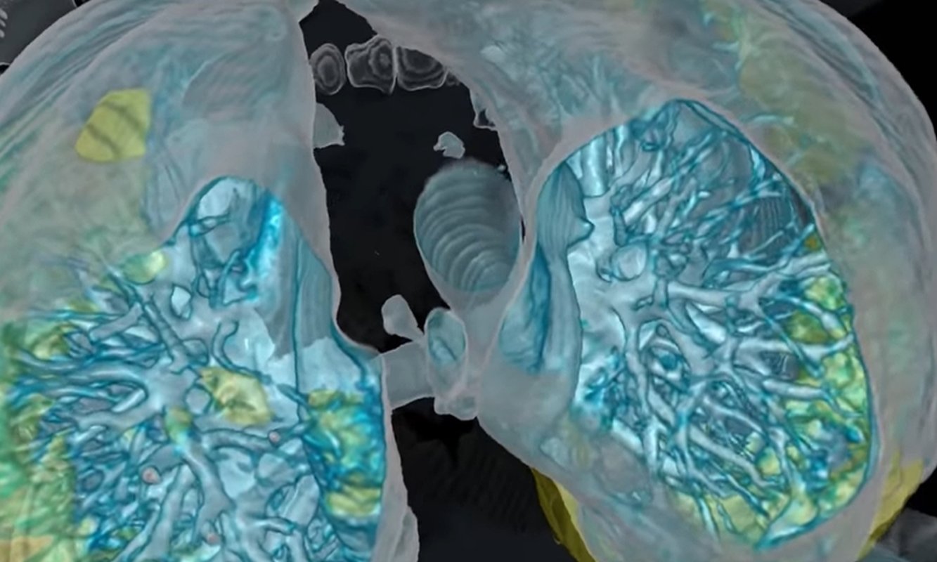 Pericolul COVID-19 pentru plămâni 162344