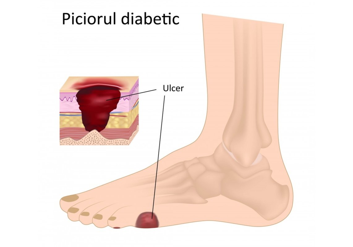 Prevenirea piciorului diabetic 222370