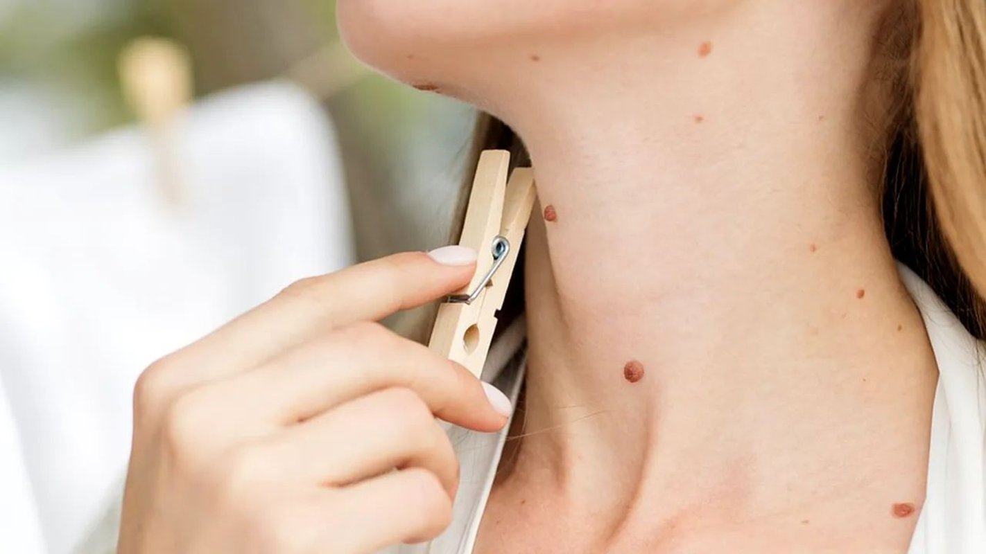 Cum recunoaștem alunițele cancerigene 244896