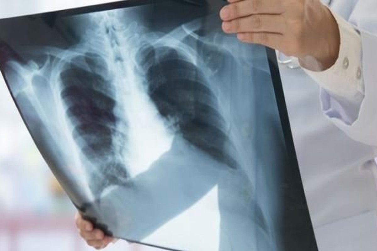 Creștere a cazurilor de tuberculoză 248675