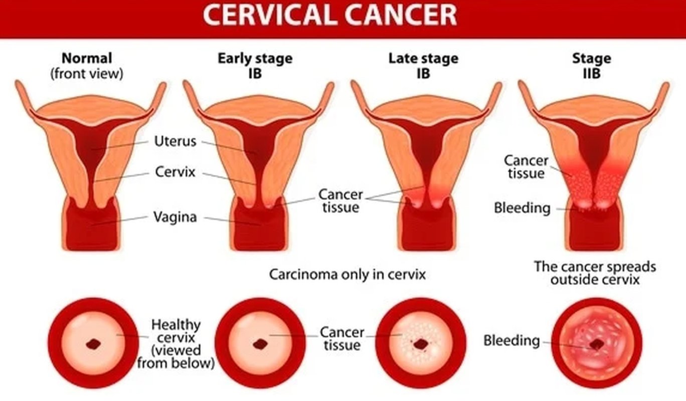 Cancerul poate fi depistat timpuriu 286286