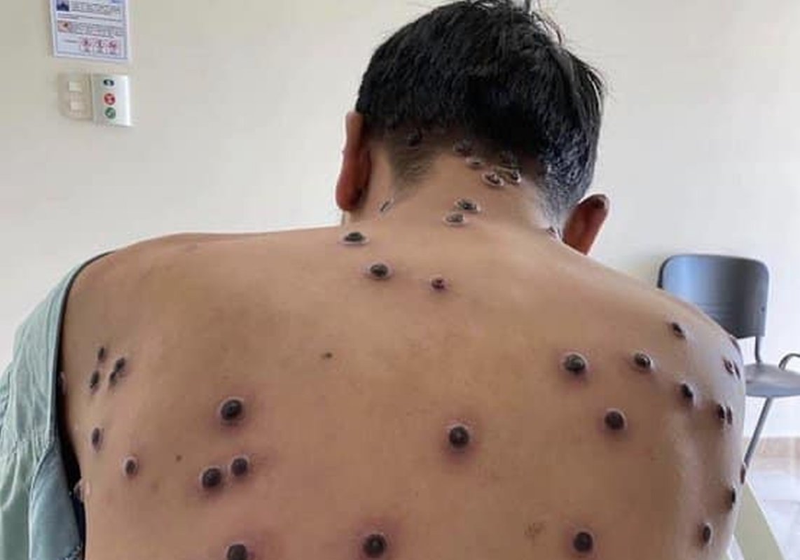 Epidemia de mpox, urgenţă de sănătate la nivel global 306231