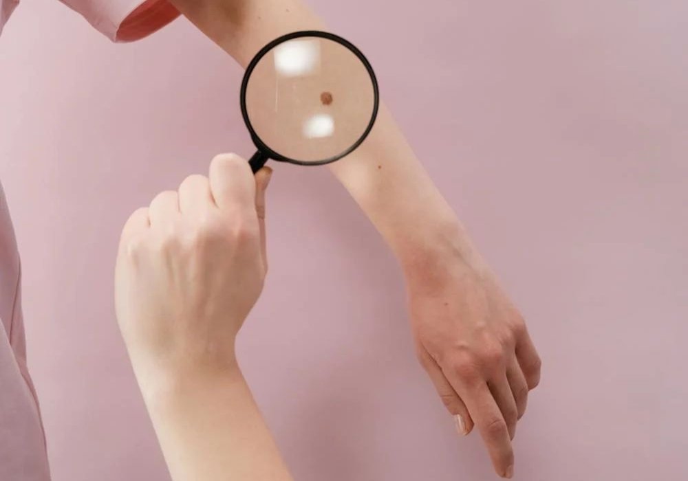 Boli dermatologice care cresc riscul de cancer de piele 325834