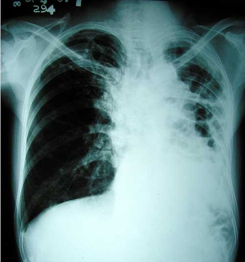 Factori favorizanţi în apariţia tuberculozei Poza 97501