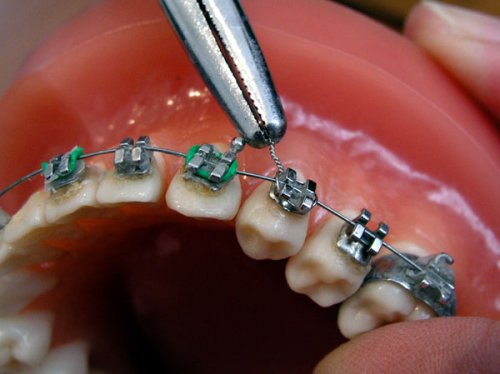 Când sunt recomandate aparatele dentare Poza 98027