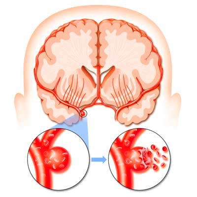 Ce tulburări pot apărea după un accident vascular cerebral Poza 98064