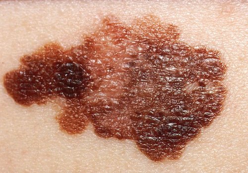 Campanie naţională de prevenire a melanomului Poza 77927