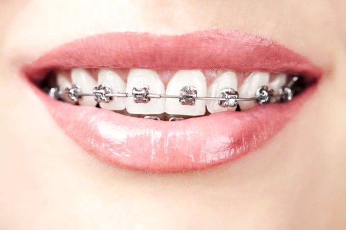 Tratamente ortodontice valabile și pentru adulţi Poza 58265
