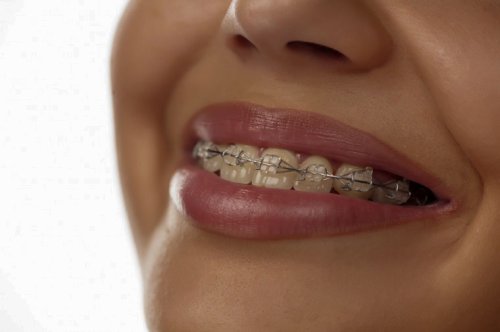 Tratamente ortodontice valabile și pentru adulţi Poza 58267