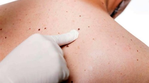 Depistat la timp, melanomul poate fi vindecat Poza 56646