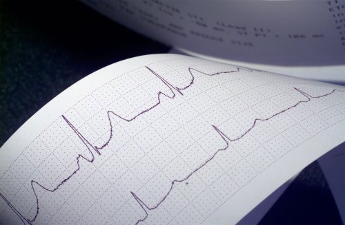 Electrocardiograma - când inima desenează