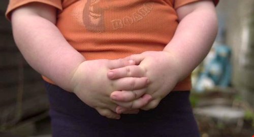 Obezitatea în copilărie, risc de scleroză multiplă Poza 151588