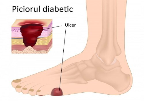 Piciorul diabetic - cum pot fi prevenite complicațiile