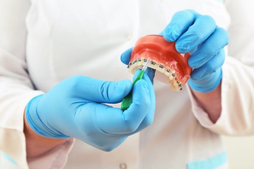 Aparatele dentare, soluția pentru dinți sănătoși