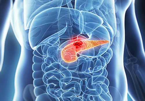 Simptome timpurii ale cancerului de pancreas Poza 192442