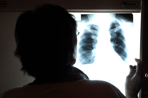 Tuberculoza, o boală vindecabilă Poza 248002