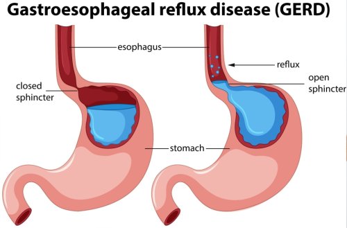 Hernia hiatală, tratată cu medicamente sau chirurgical? Poza 294850