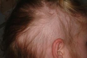 Cum recunoaştem dermatomicozele pielii capului la copil