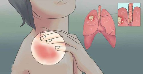 Importanța informării și diagnosticării  la timp a cancerului pulmonar