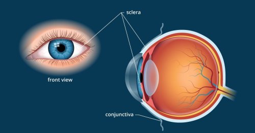 Anomalii oculare la unele cazuri grave de COVID-19 