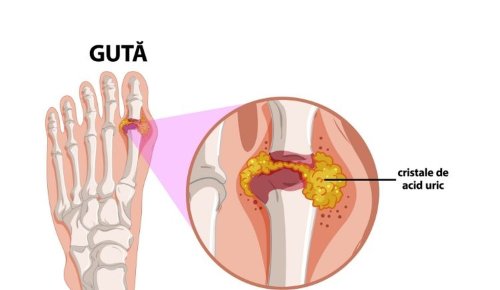 Guta, cea mai dureroasă formă de artrită