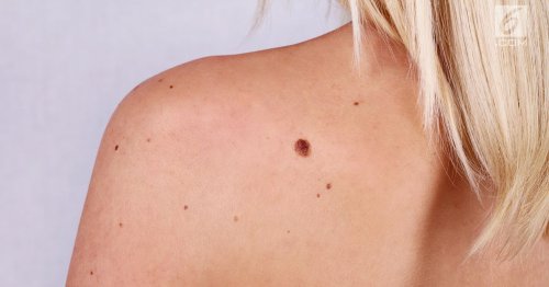 Campanie de prevenție a cancerului de piele