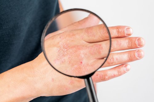 Dermatita atopică, o boală a pielii care afectează şi starea psihică