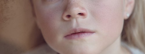 „Boala obrajilor pălmuiți” afectează tot mai mulți copii
