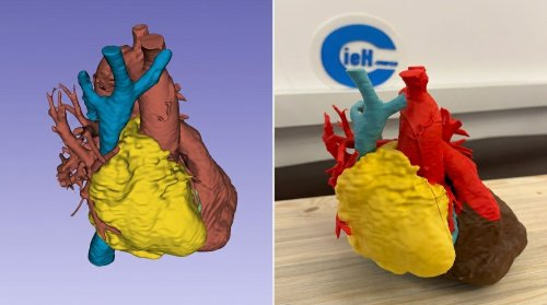 Printarea 3D în chirurgia cardiovasculară - planning preoperator personalizat 